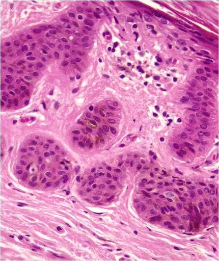 View Of An Insight Into The Histopathology Of Oral Neoplasms With