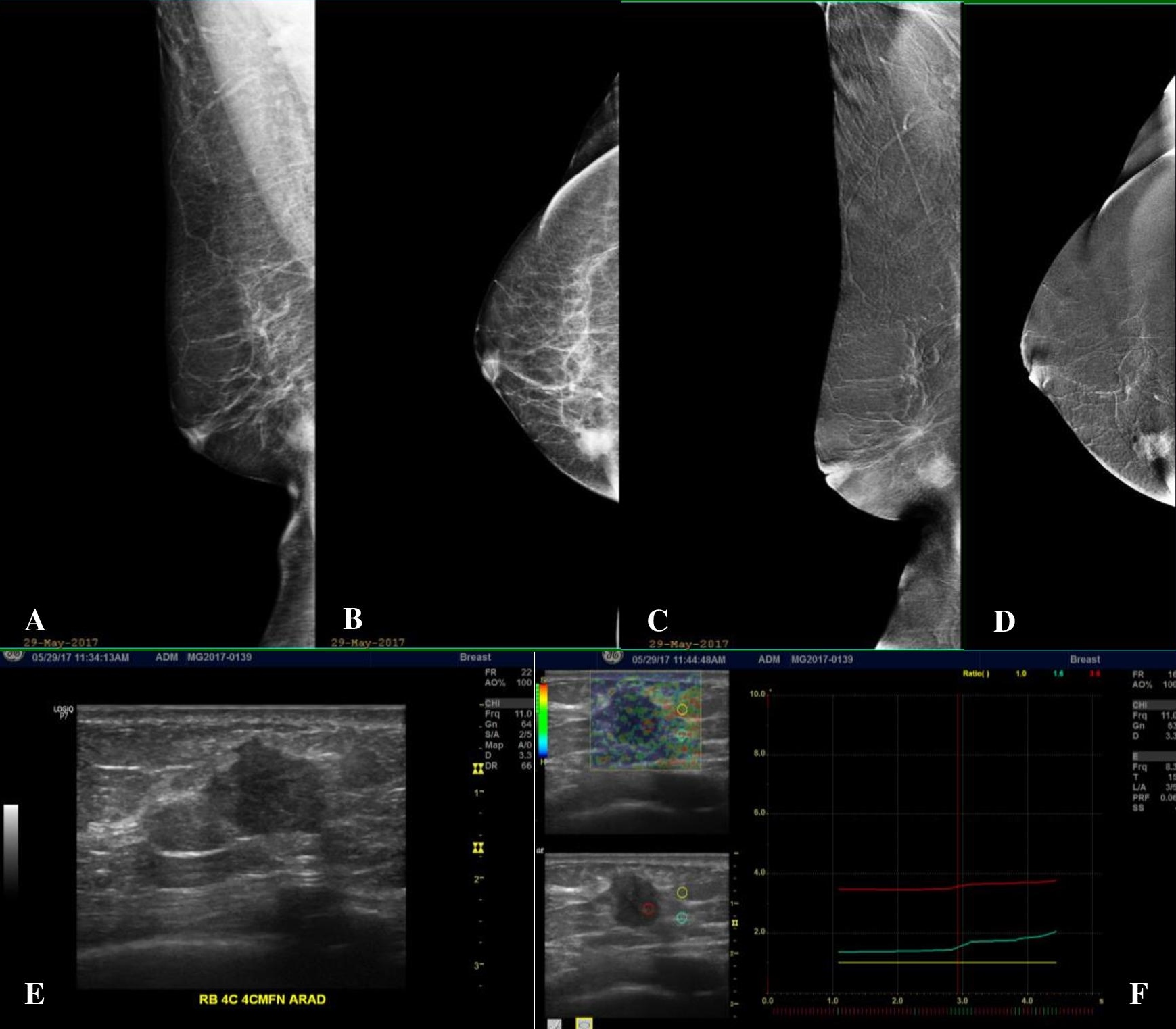 View Of Contrast Enhanced Spectral Mammography A Radiologic Pathologic Perspective Of A Novel Functional Imaging Modality For Breast Cancer Pjp